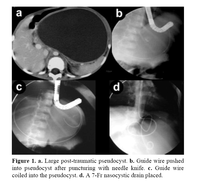 pancreas-post-traumatic-pseudocyst