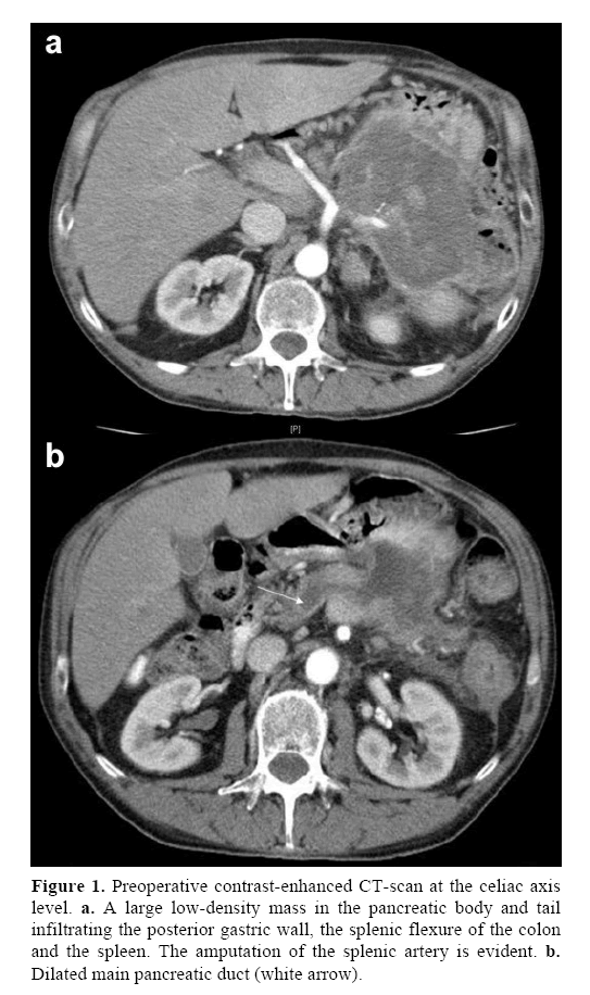 pancreas-posterior-gastric-wall