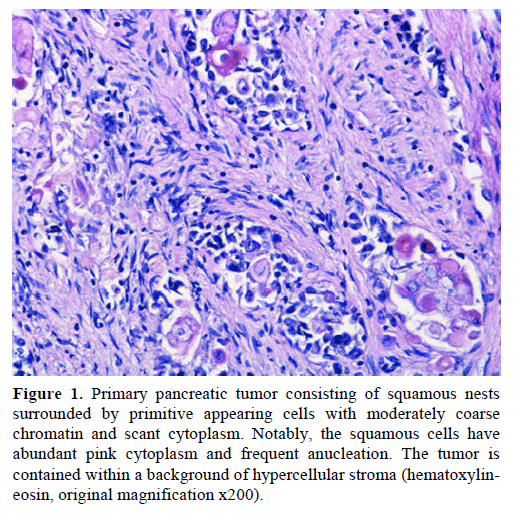 pancreas-primary-pancreatic-tumor