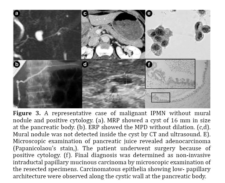 Predictors Of Malignancy In Branch Duct Intraductal Papillary Mucinous ...