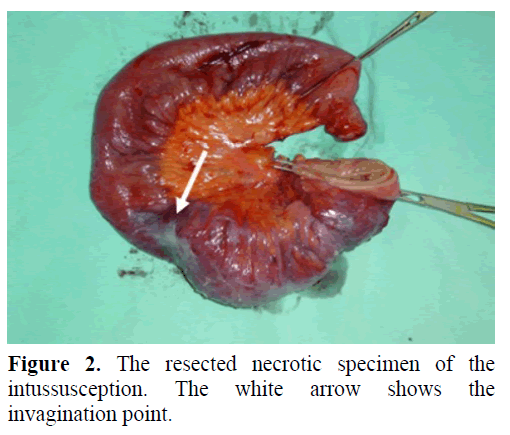pancreas-resected-necrotic-specimen