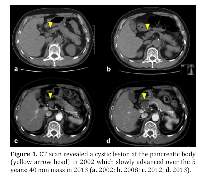 pancreas-revealed-cystic-lesion