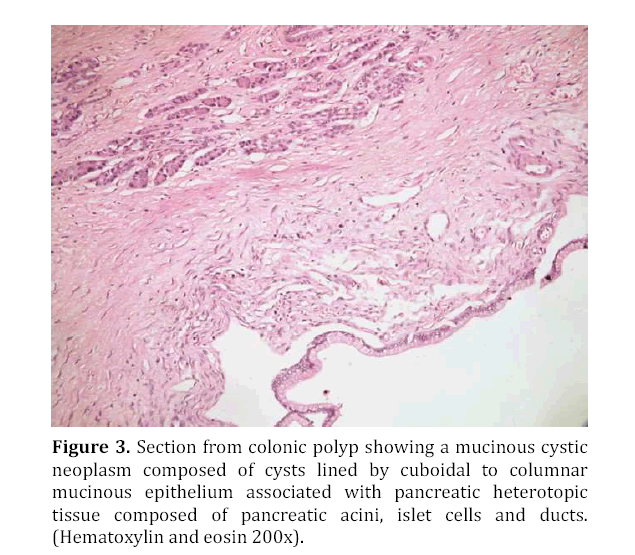 pancreas-section-from-colonic-polyp