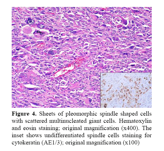 pancreas-sheets-pleomorphic-spindle