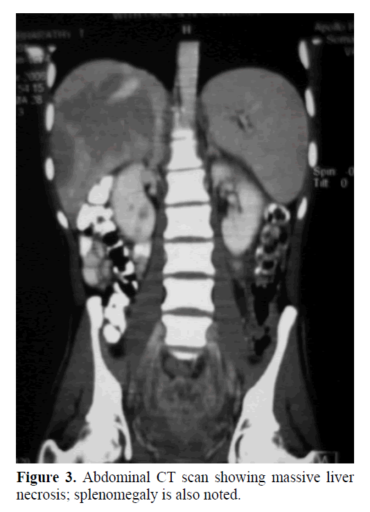 pancreas-showing-massive-liver