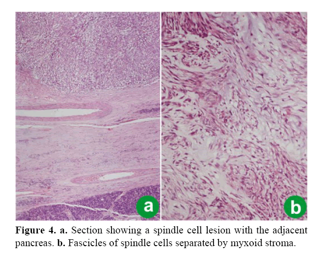 pancreas-spindle-cell-lesion