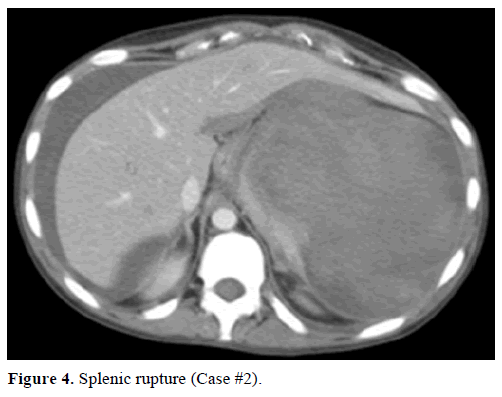 pancreas-splenic-rupture