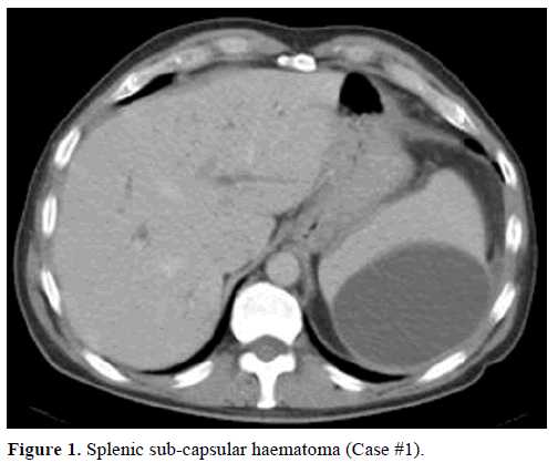 pancreas-splenic-sub-capsular-haematoma