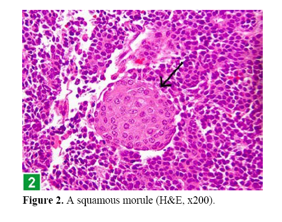 pancreas-squamous-morule