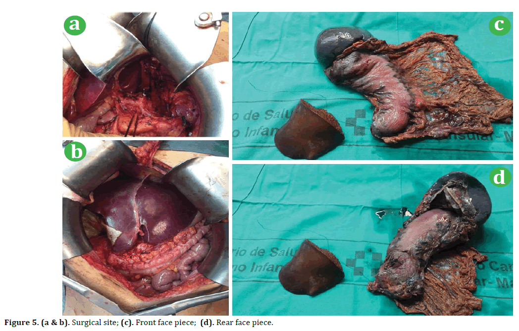 pancreas-surgical-site