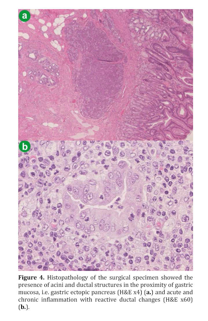 pancreas-surgical-specimen-showed