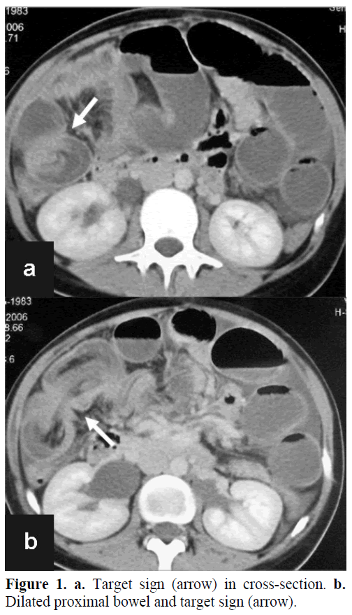 pancreas-target-sign-cross-section