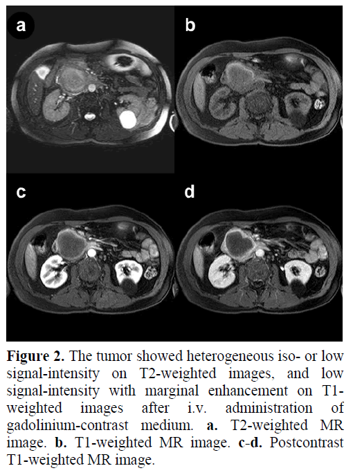 pancreas-tumor-heterogeneous-signal-intensity