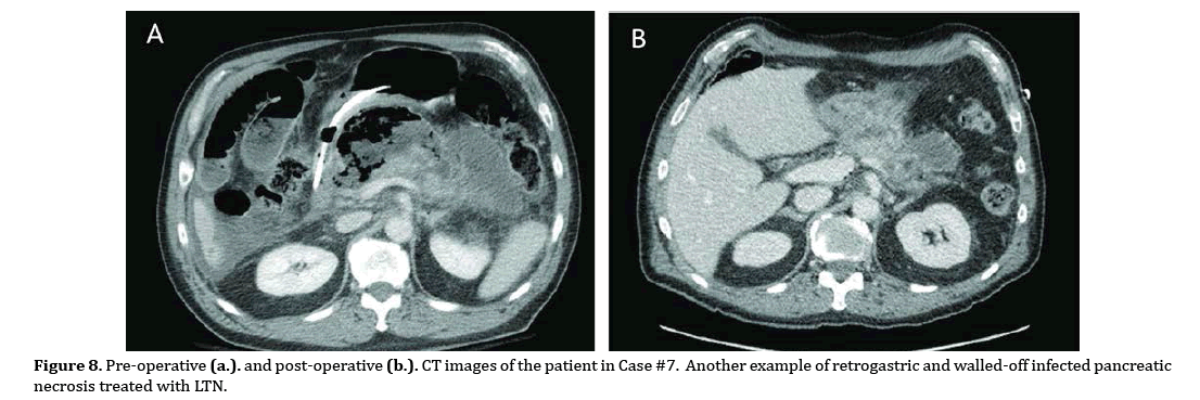 pancreas-walled-off-infected