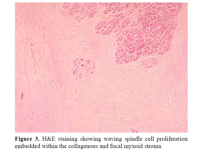 pancreas-waving-spindle-cell-proliferation