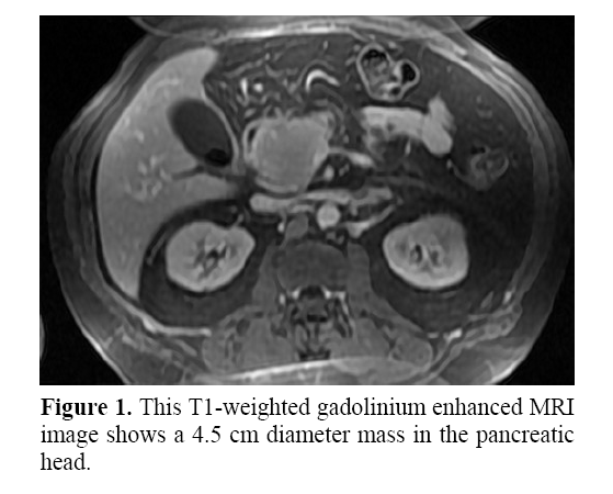 pancreas-weighted-gadolinium-enhanced