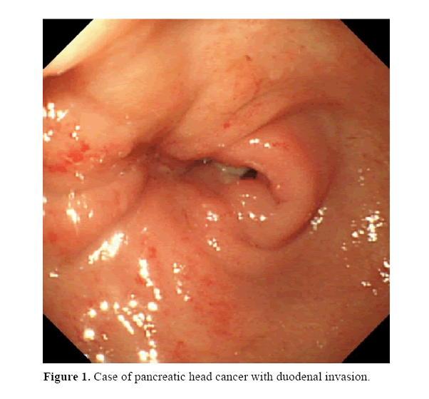 pancreas-with-duodenal-invasion