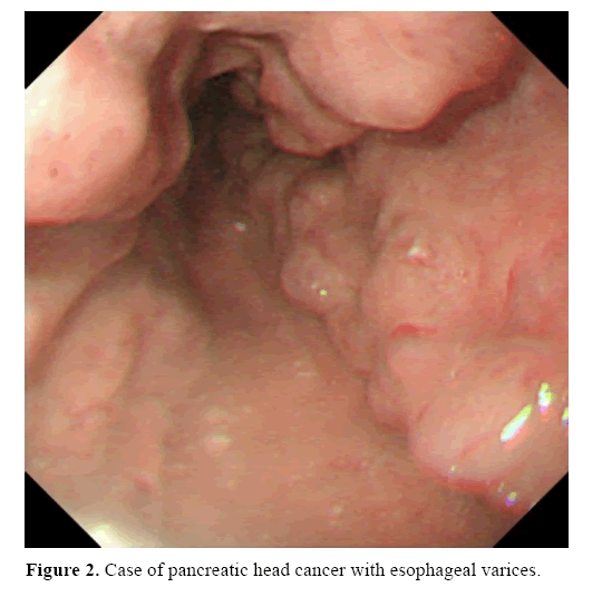 pancreas-with-esophageal-varices