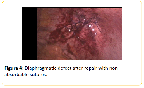 traumatic diaphragmatic hernia