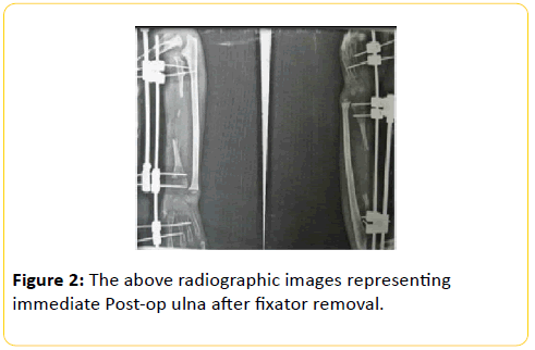 trauma-acute-care-Post-op-ulna