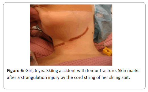 trauma-acute-care-femur