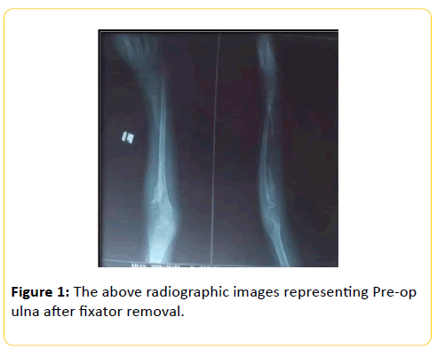 trauma-acute-care-fixator-removal