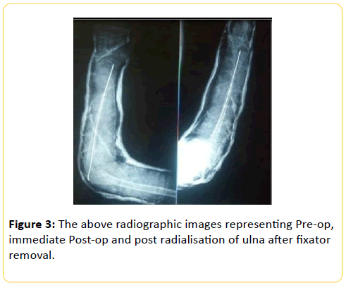 trauma-acute-care-post-radialisation