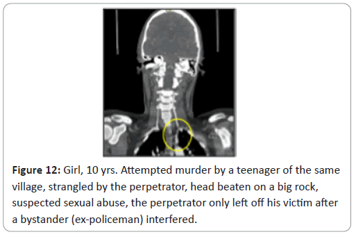 trauma-acute-care-strangled